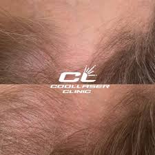 Первые волосы на письке |Восстановление волос и лечение облысения в Киеве - Coolaser