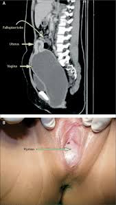 child hymen |Physical examination revealed no bulging or other pathological findings...  | Download Scientific Diagram