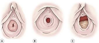  child labia hymen|Kids Health Info : Labial fusion