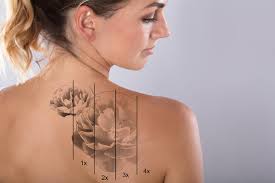 remove tattoo stock|Tattoo removal hi-res stock photography and images - Page 2 - Alamy
