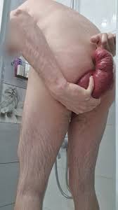 Xegldnsejtwv jpg x Prolapse anal