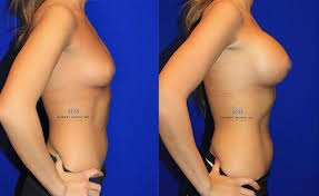 Pbd sklavinmichaela fill up boobs overfill implants expanders jpg x Breast implants