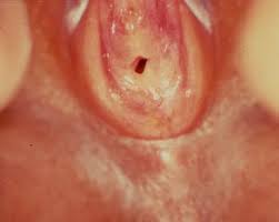  child labia hymen|Clinical Practice Guidelines : Vulval and Vaginal Conditions