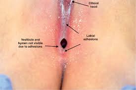 hymen child|a) Semilunar hymen. (b) Cribriform hymen. (c) Septate hymen. (d)... |  Download Scientific Diagram