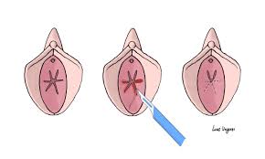 hymen child|Understanding Medical Findings in Child Sexual Abuse: An Update For 2018 -  Joyce A. Adams, 2018
