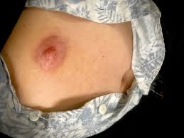 tiny puff nipples|How to Hide Puffy Nipples in Men | Gynecomastia LA