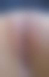 陰核まんこ無修正|症例写真】クリトリス包茎の症例：美容外科 高須クリニック