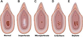 hymen child|Diagnosis of Child Sexual Abuse