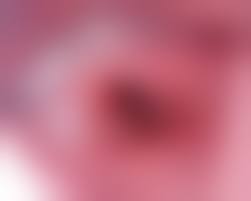 hymen child|A 13-Year-Old Girl with Primary Amenorrhea | NEJM Evidence