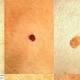 5 tips for checking your moles for skin cancer 