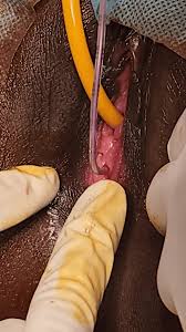 hymen child|Microperforate (Pinhole) hymen and infertility; a rare case report