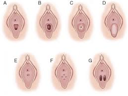 hymen child|Normal Examination Findings and Variants | SpringerLink