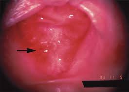 hymen child|Marrow - In Marrow Q Bank: AIIMS Mock 2017 Q. In case of rape of children,  the hymen is A. Not ruptured because it is highly elastic B. Not ruptured  because it