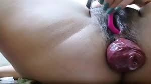 Anal prolapse jpg x Anal prolapse