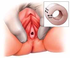 hymen child|Imperforate Hymen | Children's Hospital Colorado