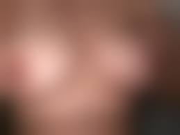 budding nipples|Breast Buds | ROJoson Medical Clinic