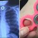Texas girl chokes on fidget spinner part 