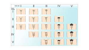puberty pubic hair|A 10-Month-Old Infant Presenting With Signs of Precocious Puberty Secondary  to a Sclerosing Stromal Tumor of the Ovary in the Absence of Hormonal  Elevation - Anthony I Squillaro, Shengmei Zhou, Stefanie M