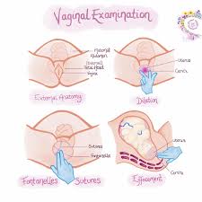 child examination vagina|Imperforate hymen presenting as vaginal cyst in a 16-month-old child –  considerations for an early diagnosis - Nedeljka Glavan, Herman Haller,  Alemka Brnčić–Fischer, Lana Glavan-Gačanin, Damir Miletić, Nives Jonjić,  2016