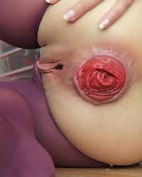 Prolapse porn close up webcam clara blow fucks her gaping anal cunt open even more perverted porn videos jpg x Gaping prolapse