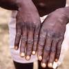 Mpox Declared a Continental Emergency in Africa: A Global Health Concern