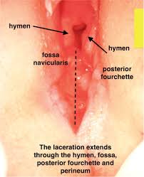 hymen child|Child abuse pediatrician corrects falsehoods about virginity with a vital  anatomy lesson - Upworthy