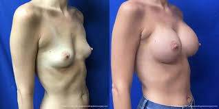 Big fake breast implants black hair bimbo ai porn jpg x Breast implants