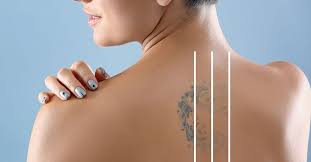 remove tattoo stock|Laser tattoo removal from shoulder Stock Photo | Adobe Stock