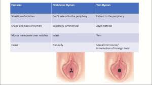 hymen child|Imperforate Hymen: Congenital or Acquired From Sexual Abuse?V