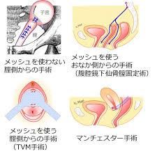 子宮脱|骨盤臓器脱（子宮脱など） | 栃木県下野市の婦人科・内科 | 木村クリニック
