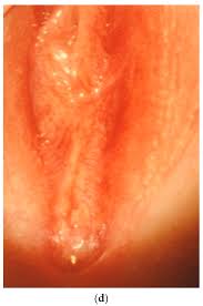 child hymen |Annular hymenotomy for imperforate hymen - Cetin - 2016 - Journal of  Obstetrics and Gynaecology Research - Wiley Online Library