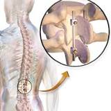 Spinal Implants Market is Growing at a CAGR of 5.40%, Delveinsight