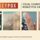 Monkeypox is not a one-off