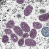 Second suspected case of monkeypox identified in Santa Clara County