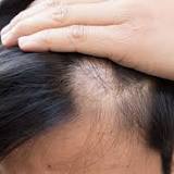 The FDA Has Approved Olumiant for the Treatment of Alopecia Areata