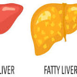 SRL Diagnostics launches Fatty Liver Index