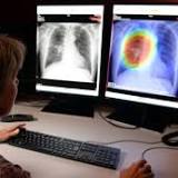 AI algorithm helps Somerset clinicians detect lung cancer faster