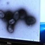 Florida reports 4 additional monkeypox cases in Pinellas, 1 in Polk