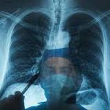 World Lung Cancer Day: How Smoking Increases Lung Cancer Risk?