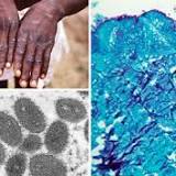 Monkeypox: WHO warns virus spreading in sexual networks. Can the virus lead to another pandemic?