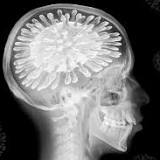 Covid attacks the brain, new studies 'confirm' the subtle danger of this virus