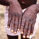 4 Fast Facts about monkeypox