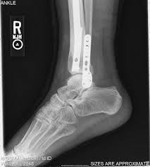 ankle fracture value