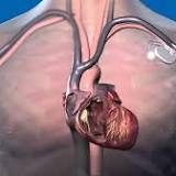Global Cardiac Catheters and Guidewires Market (2022-2028) Outlook By Players Abbott Laboratories, Boston ...