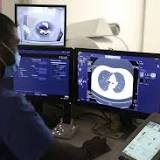 AI-Based Tool Helps Physicians To Predict Cancer Risk of Lung Nodules