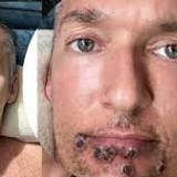 Monkeypox Infected Patient's Post On Timeline Of Painful Symptoms of Rash Goes Viral - CHECK Photo