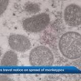 Monkeypox Warning Issued for Canadian Travellers