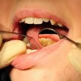 'Turkey teeth' are giving UK dentists nightmares