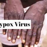 Health ALERT! Monkeypox evolving, mutating at a rapid pace; 50 genetic variations found with new strain: Study