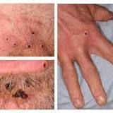 Monkeypox: the table clarifies the symptoms and transmission